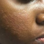 Rosacea Rosacea