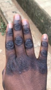 Uneven skin tone and knuckles