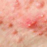 cyst acne cyst acne