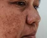 melasma melasma