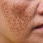 pigmentation pigmentation