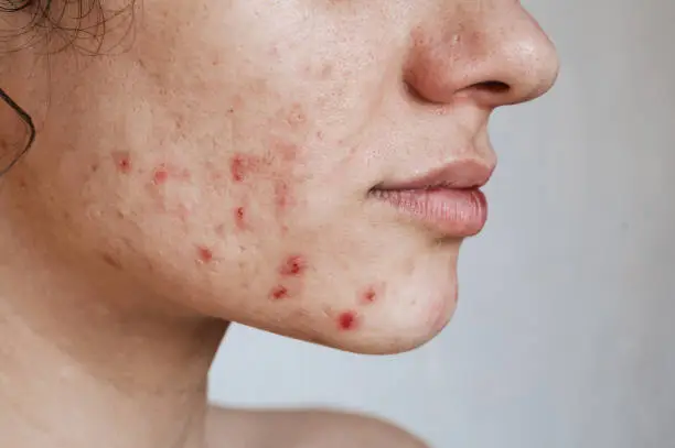 close-up of the face of a young girl with a damaged skin barrier