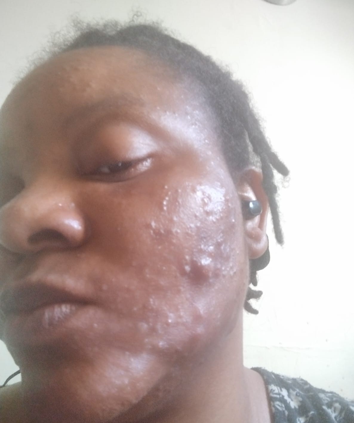 Before acne treatment from Czarina Beauty Homes