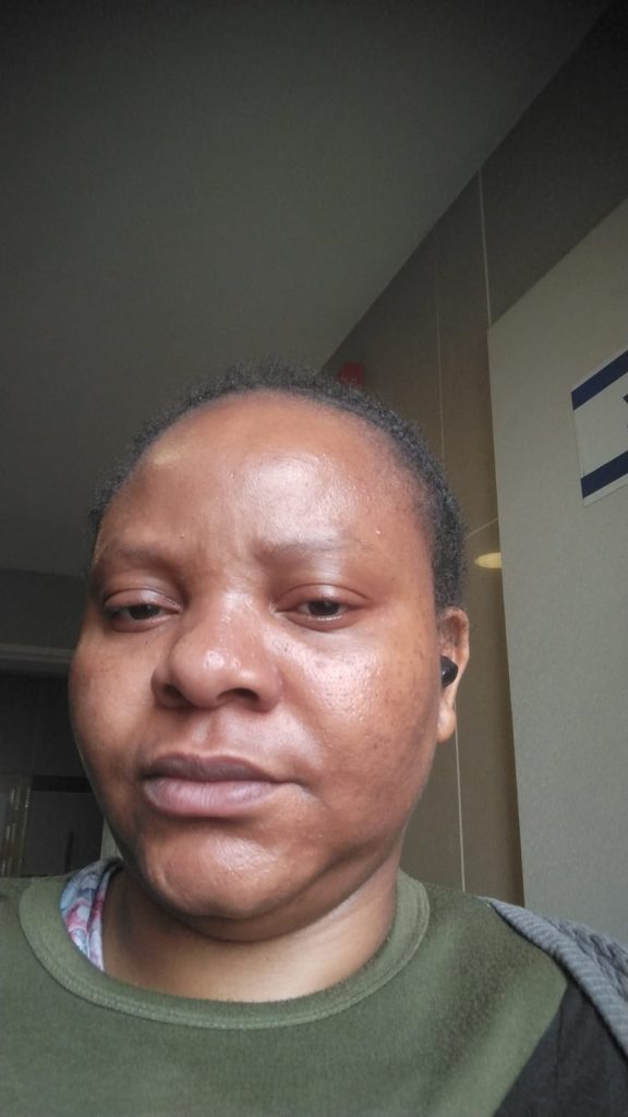 After acne treatment from Czarina Beauty Homes