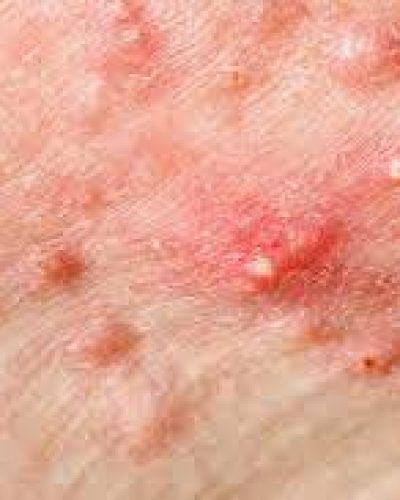 cyst acne